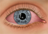 conjunctivitis